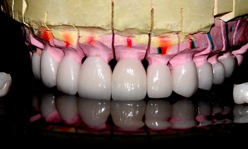 قیمت کامپوزیت دندان در اهواز چقدر است ؟