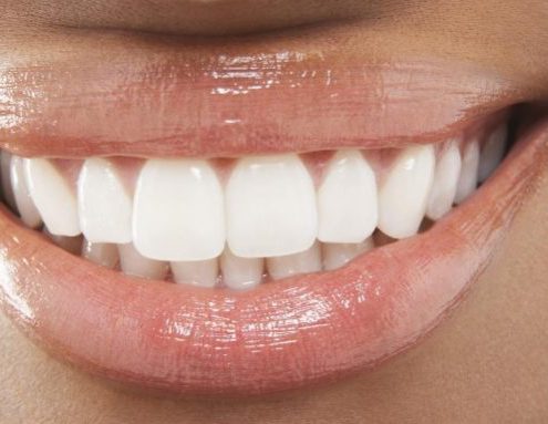 طول عمر کامپوزیت دندان اهواز و لمینت دندان اهواز چقدر است؟