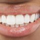 طول عمر کامپوزیت دندان اهواز و لمینت دندان اهواز چقدر است؟